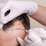 One-Time Hair Transplant for Hair Loss: Ideal or Unrealistic? 2023