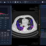 Lung ultrasonography in COVID-19 pneumonia, validated by high-resolution computed tomography and artificial intelligence 2023